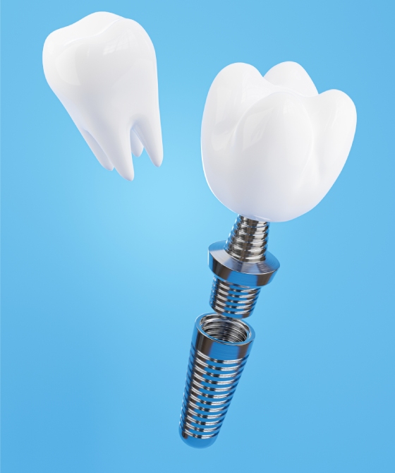Foto 3d render montaže zubnog implantata na plavoj pozadini